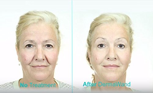 DermaWand Anti-aging System: (Review Update 2020) - Anti Aging Revolution